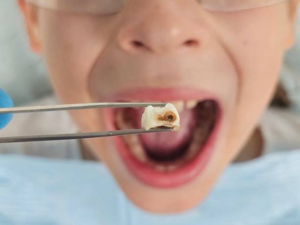 Best Emergency Dental Care for Broken or Chipped Teeth in Spindale, NC